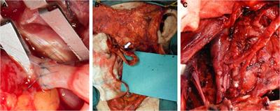 Optimization of Vascular Supply in Free Flaps for Head and Neck Reconstruction: Analysis of a Young Team’s Experience